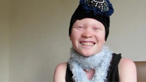 African Albino Finds Acceptance in Christ after Being Shunned by Her Own People