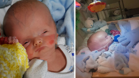 Baby with swollen head that doctors suggested be terminated is defying expectations