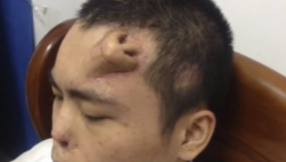 Forehead nose VIDEO, PHOTOS: Chinese man has nose grown on forehead, ready for transplant