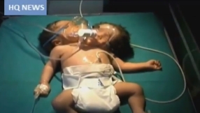 Two-headed conjoined twins die after 20 days; Family devastated but says \