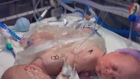 Conjoined twins in Florida survive first separation surgery, parents ask for prayers