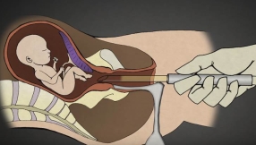 Lawmakers in West Virginia pass bill banning dismemberment abortions to protect unborn child