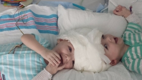 Parents of Twin Boys Joined At The Head Say God Is Their \'Biggest Hero\' After Successful Surgery to Separate Them